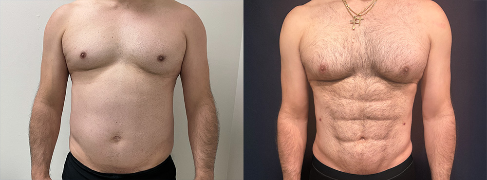 Ab Etching Before and After