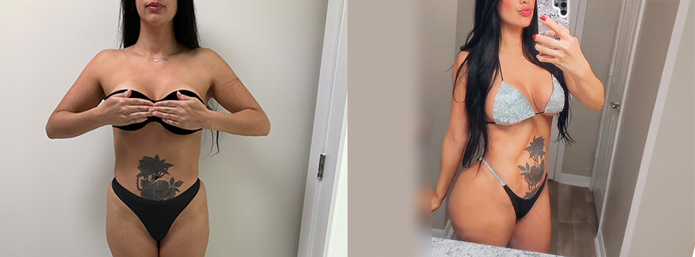 Brazilian Butt Lift Before and After