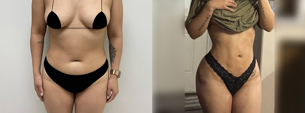 BBL Before and After in miami