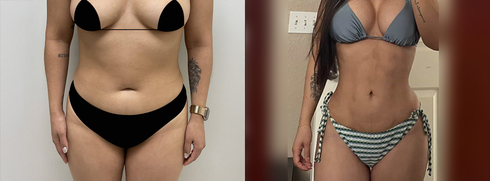 Lipo 360 Before and After