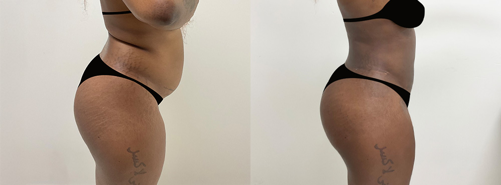Butt Lift Before and After