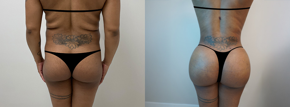 Brazilian Butt Lift Before and After