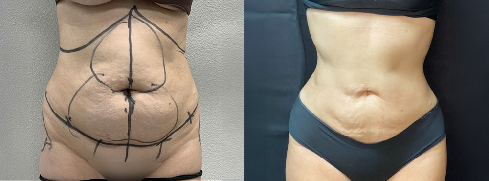 Liposuction Before and After