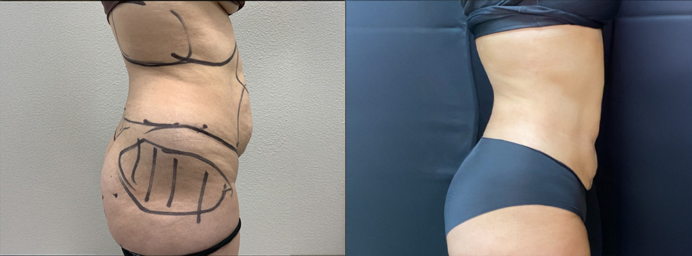 Liposuction Before and After