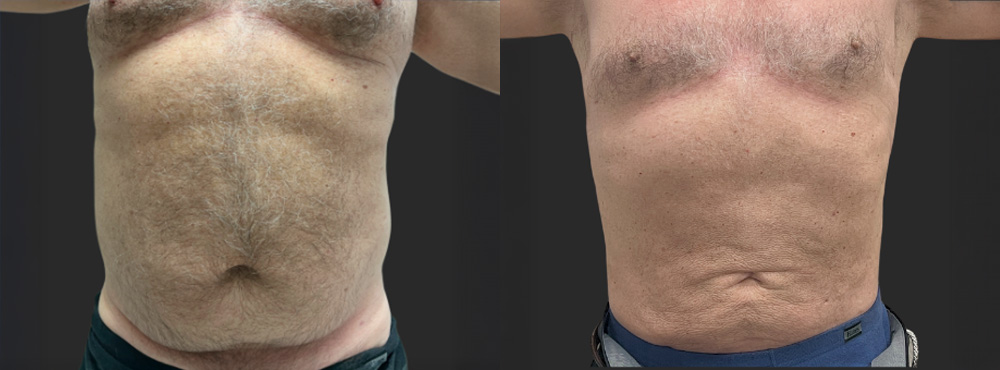 Liposuction Before and After