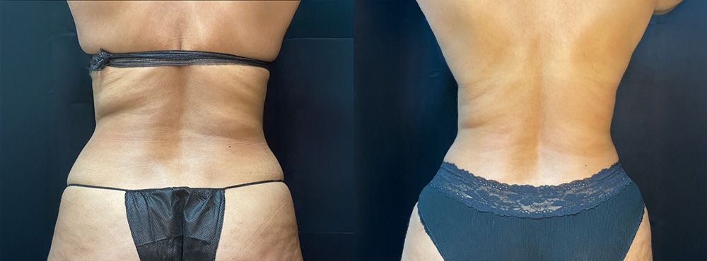 lipo 360 before and after