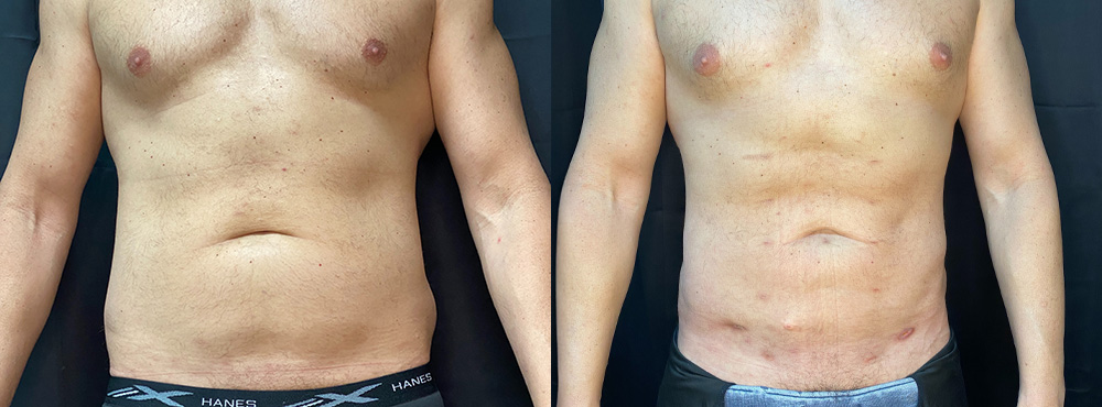 Men Lipo Before and After