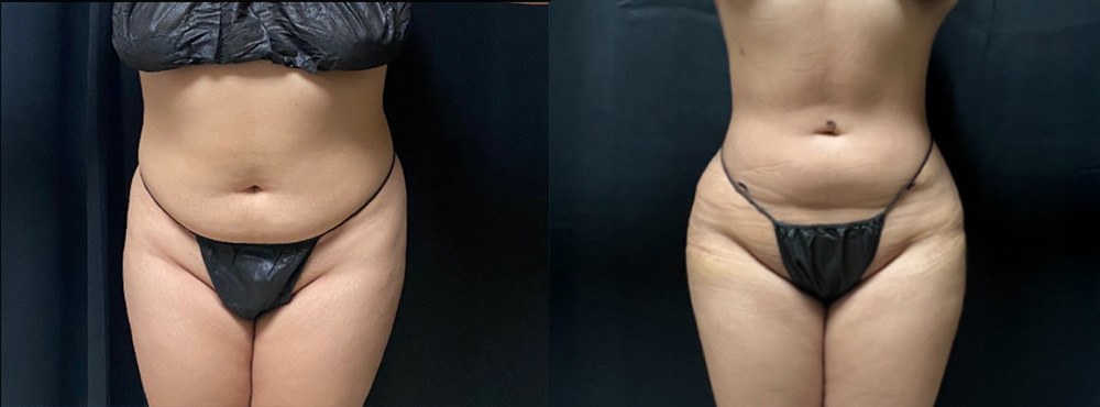 butt lift Before and after
