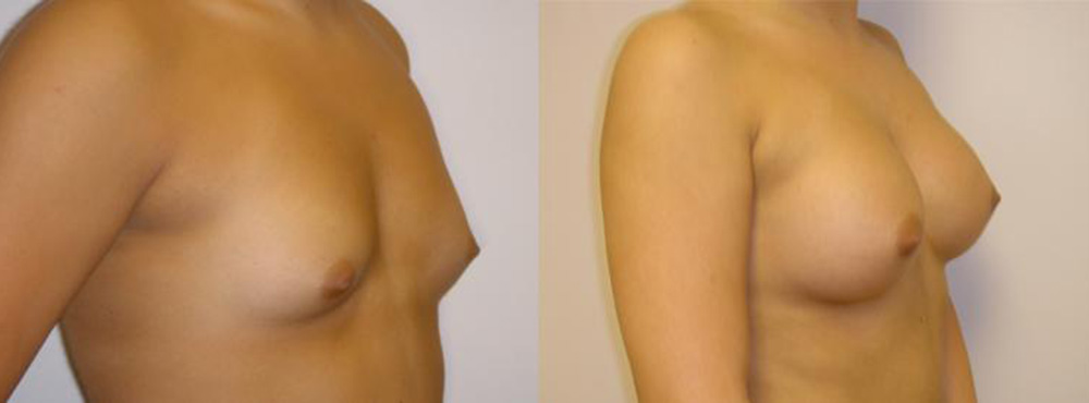 Breast Augmentation Before and After