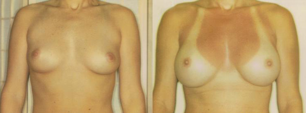 Breast Augmentation Before and After