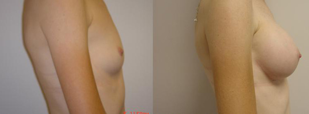 Breast Augmentation Before and After