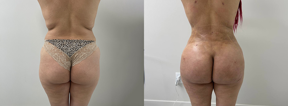 Butt Lift Before and After
