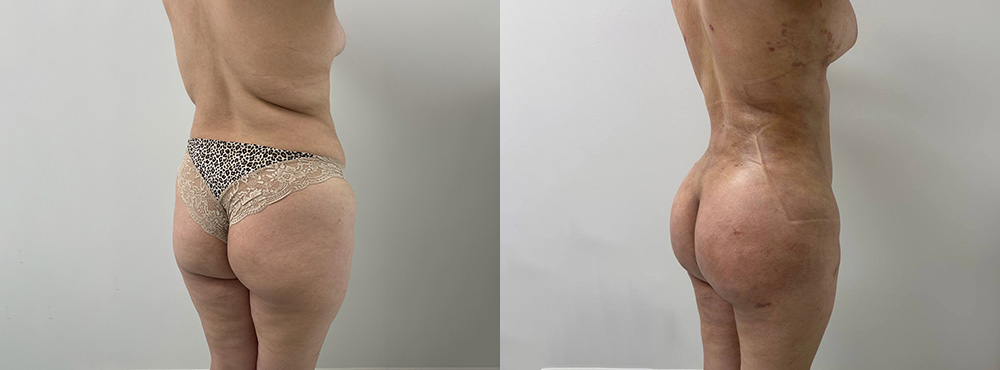 Butt Lift Before and After