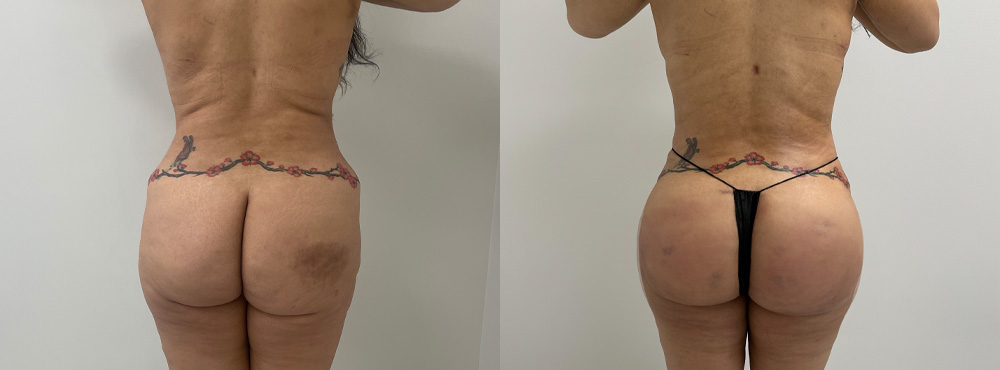 BBL Before and After