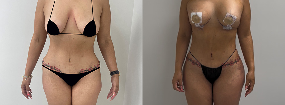 BBL Before and After