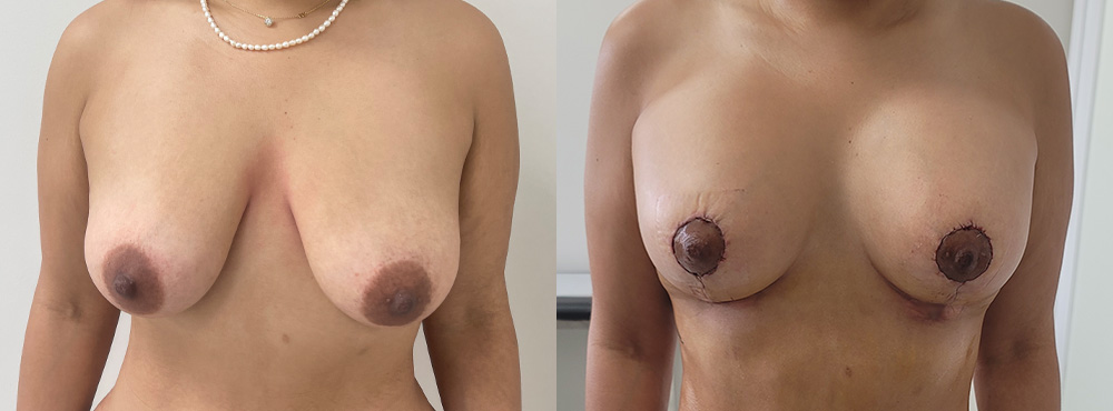 Breast Lift Before and After