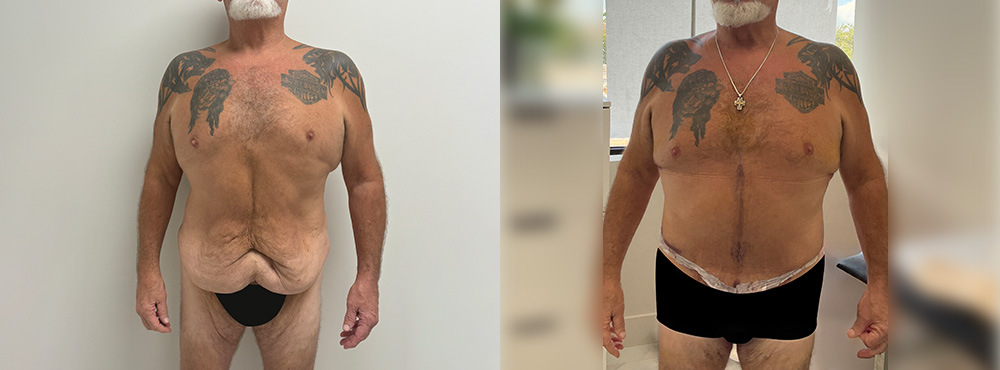 Male Tummy Tuck Before and After