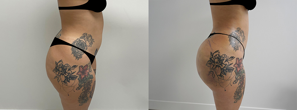Brazilian Butt Lift Before and After in Miami