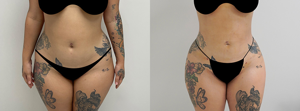 Brazilian Butt Lift Before and After in Miami