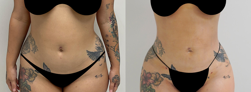 Lipo 360 Before and After in miami