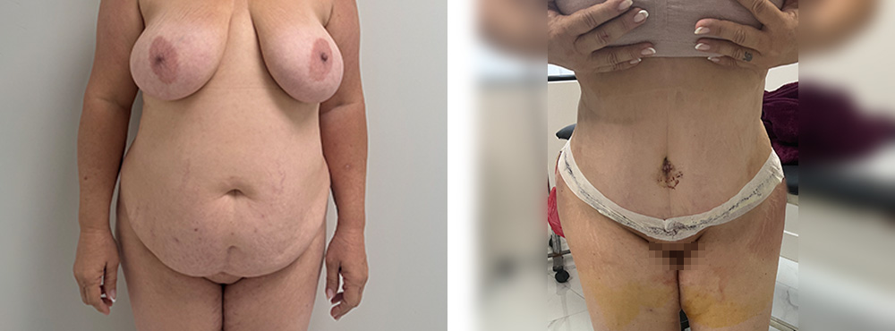 Tummy Tuck Before and After in miami