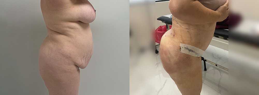 Tummy Tuck Before and After in miami