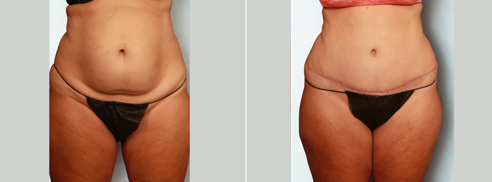 Tummy Tuck Before and After in miami