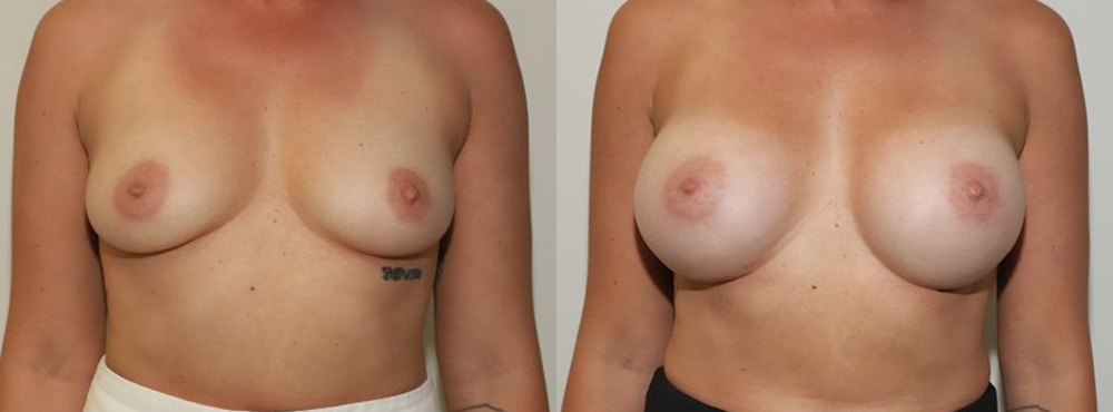 Breast Augmentation Before and After