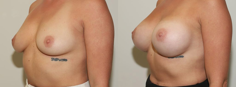 Breast Augmentation Before and After