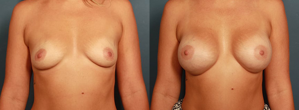 Breast Augmentation Before and After