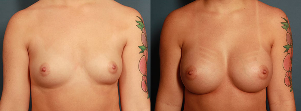 Breast Agmentation before and after