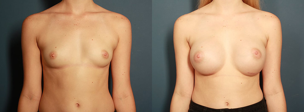Breast Augmentation before and after in miami