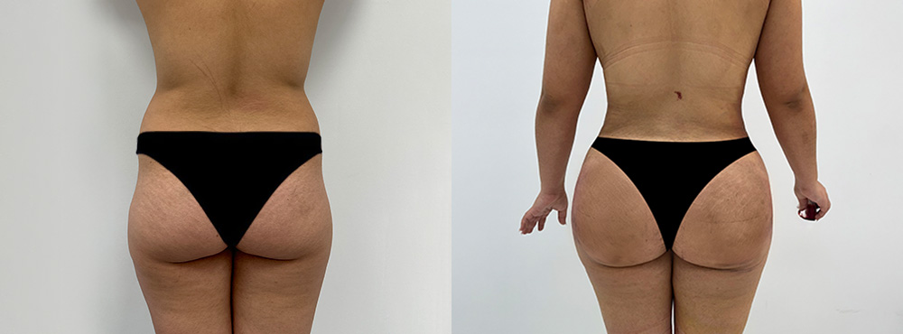 Brazilian Butt Lift Before and After