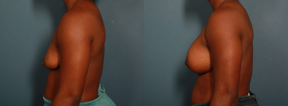 Breast Lift Before and After