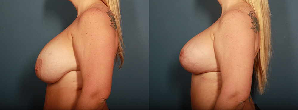 Breast Lift Before and After
