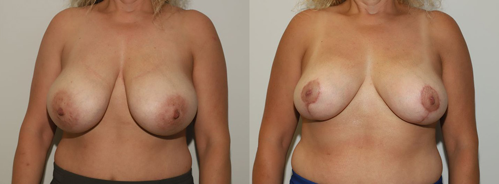 Breast Reduction before and after