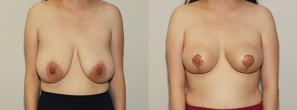 Breast Reduction Before and After