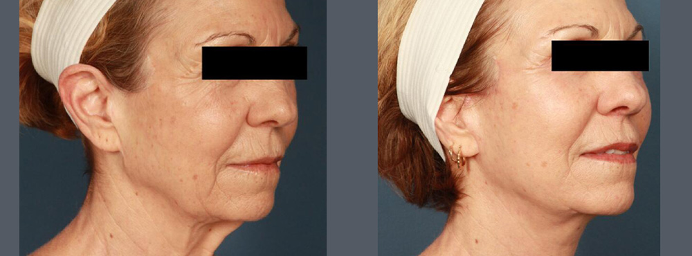Face Lift Before and After in Miami
