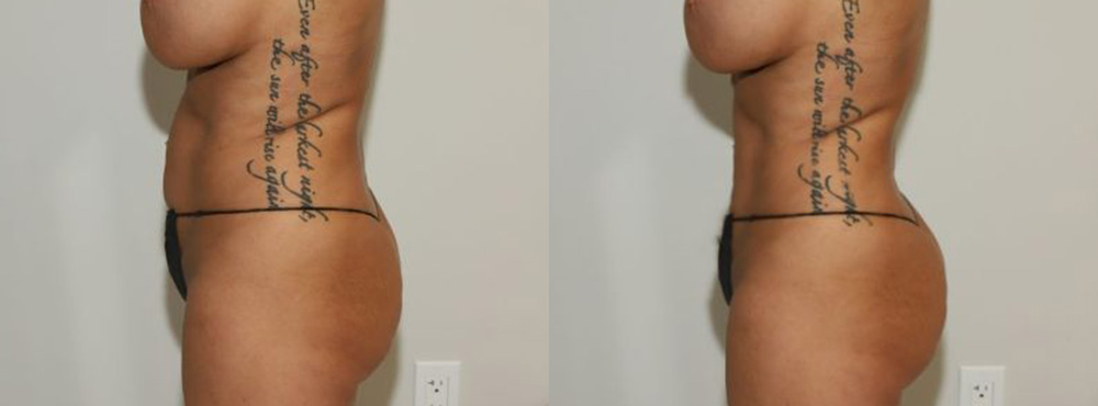 Liposuction Before and After in Miami