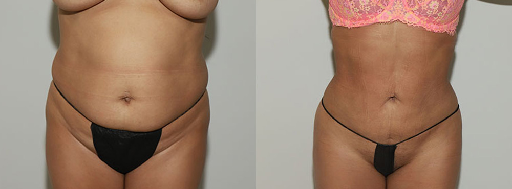 Liposuction Before and After in Miami