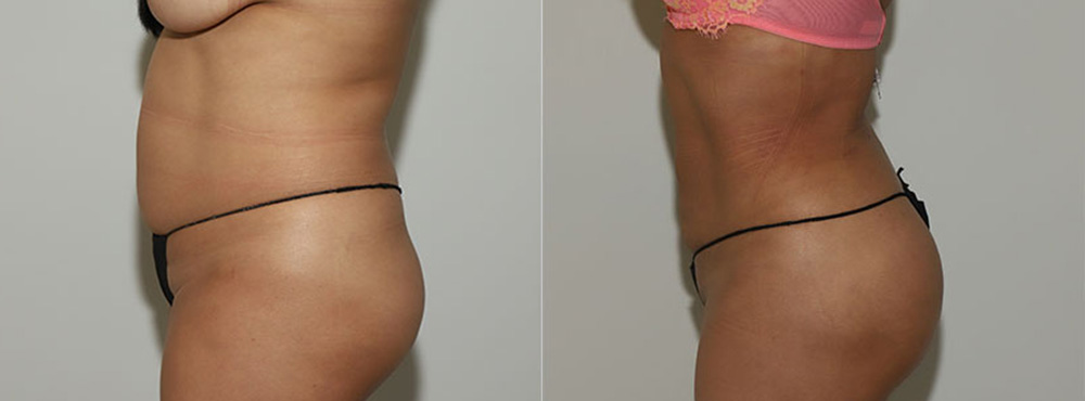 Liposuction Before and After in Miami