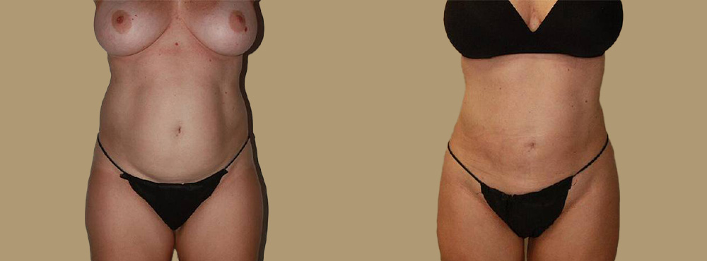 Liposuction Before and After in Miami
