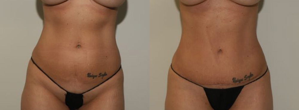 Liposuction Before and After