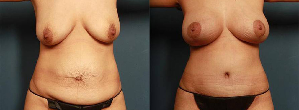 Mommy Makeover Before and After in Miami