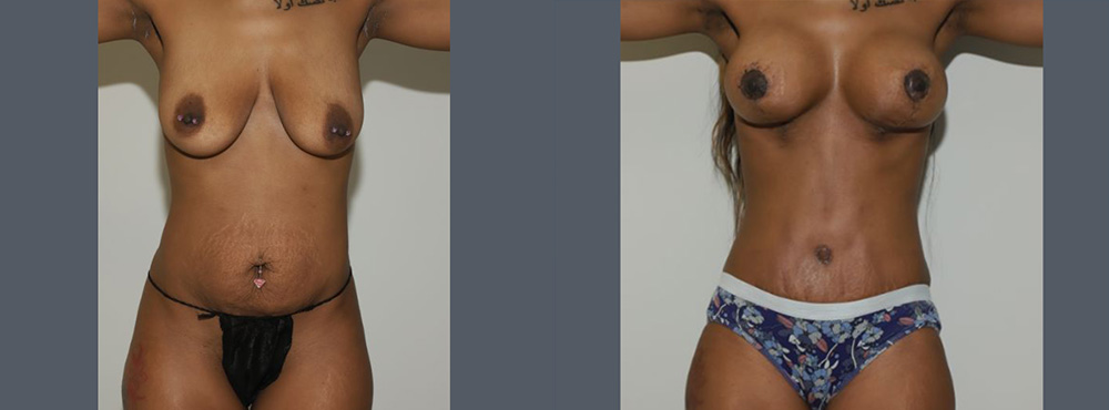 Mommy Makeover Before and After in Miami