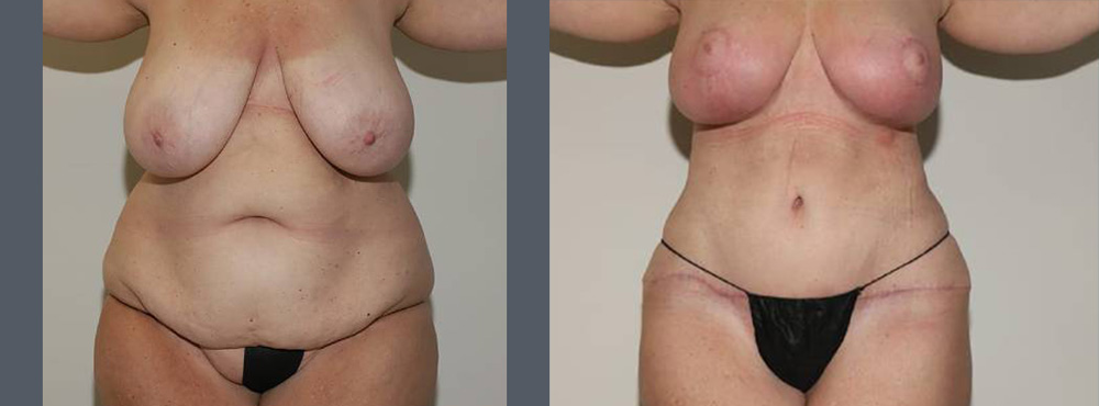 Mommy Makeover before and after