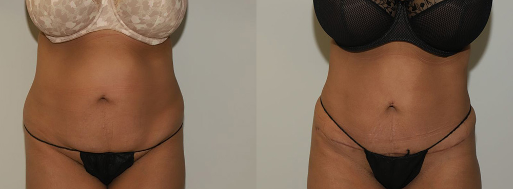 Tummy Tuck Before and After