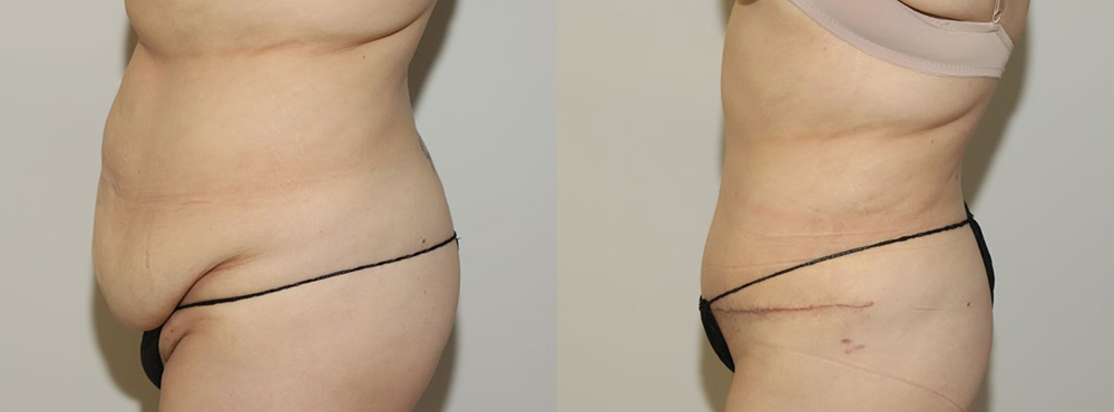 Tummy Tuck Before and After