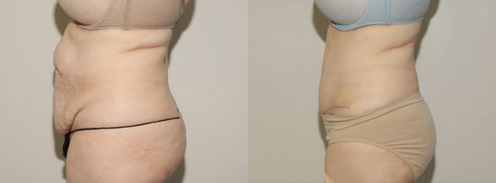 Tummy Tuck Before and After in Miami