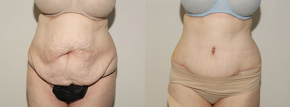 Tummy Tuck Before and After in Miami